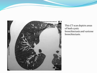 This CT scan depicts areas 
of both cystic 
bronchiectasis and varicose 
bronchiectasis. 
 