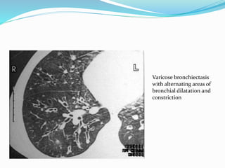 Varicose bronchiectasis 
with alternating areas of 
bronchial dilatation and 
constriction 
 