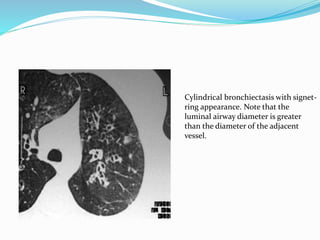 Cylindrical bronchiectasis with signet-ring 
appearance. Note that the 
luminal airway diameter is greater 
than the diameter of the adjacent 
vessel. 
 