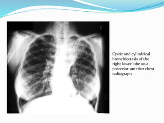 Cystic and cylindrical 
bronchiectasis of the 
right lower lobe on a 
posterior-anterior chest 
radiograph 
 