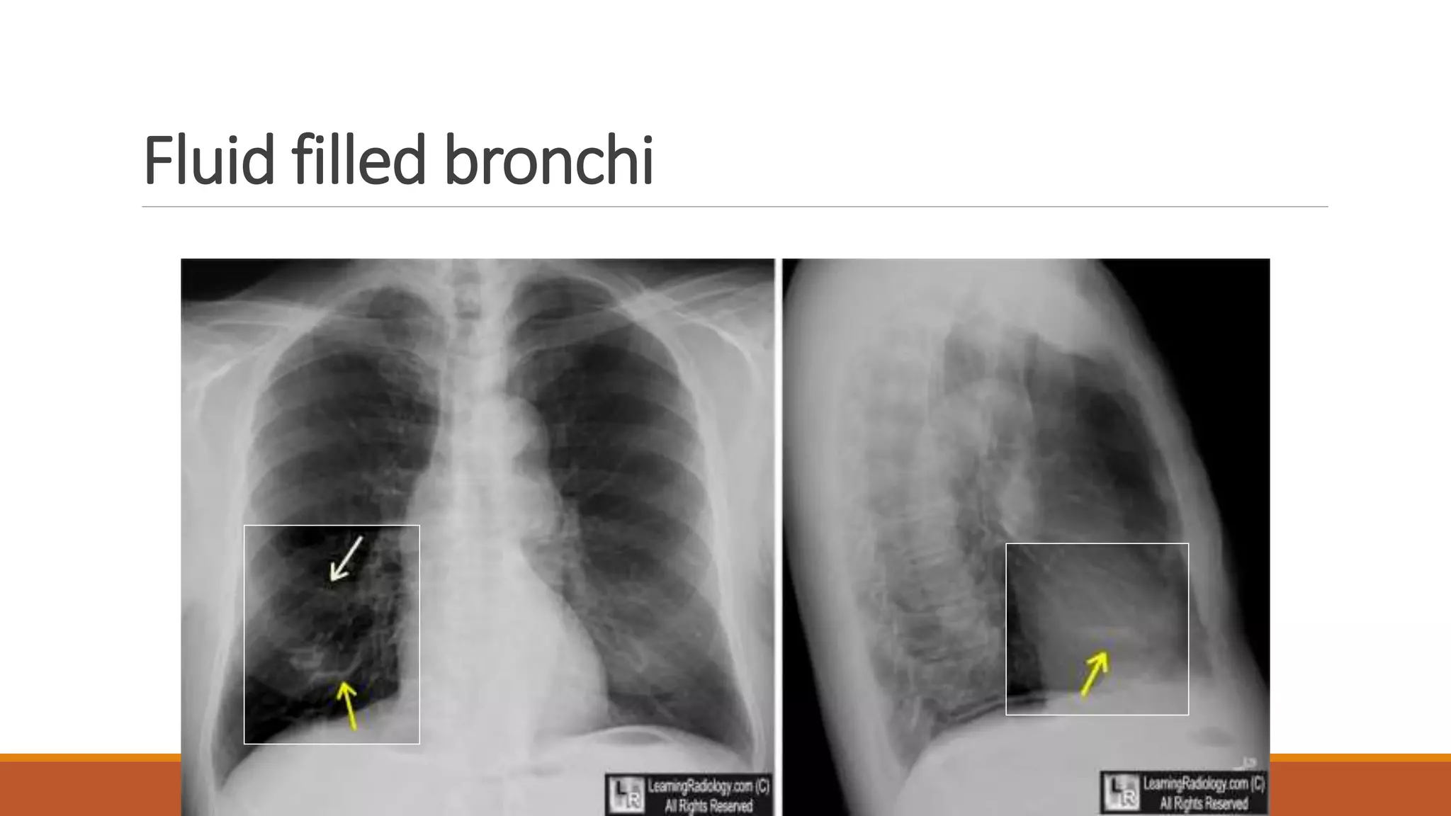 Fluid filled bronchi
 