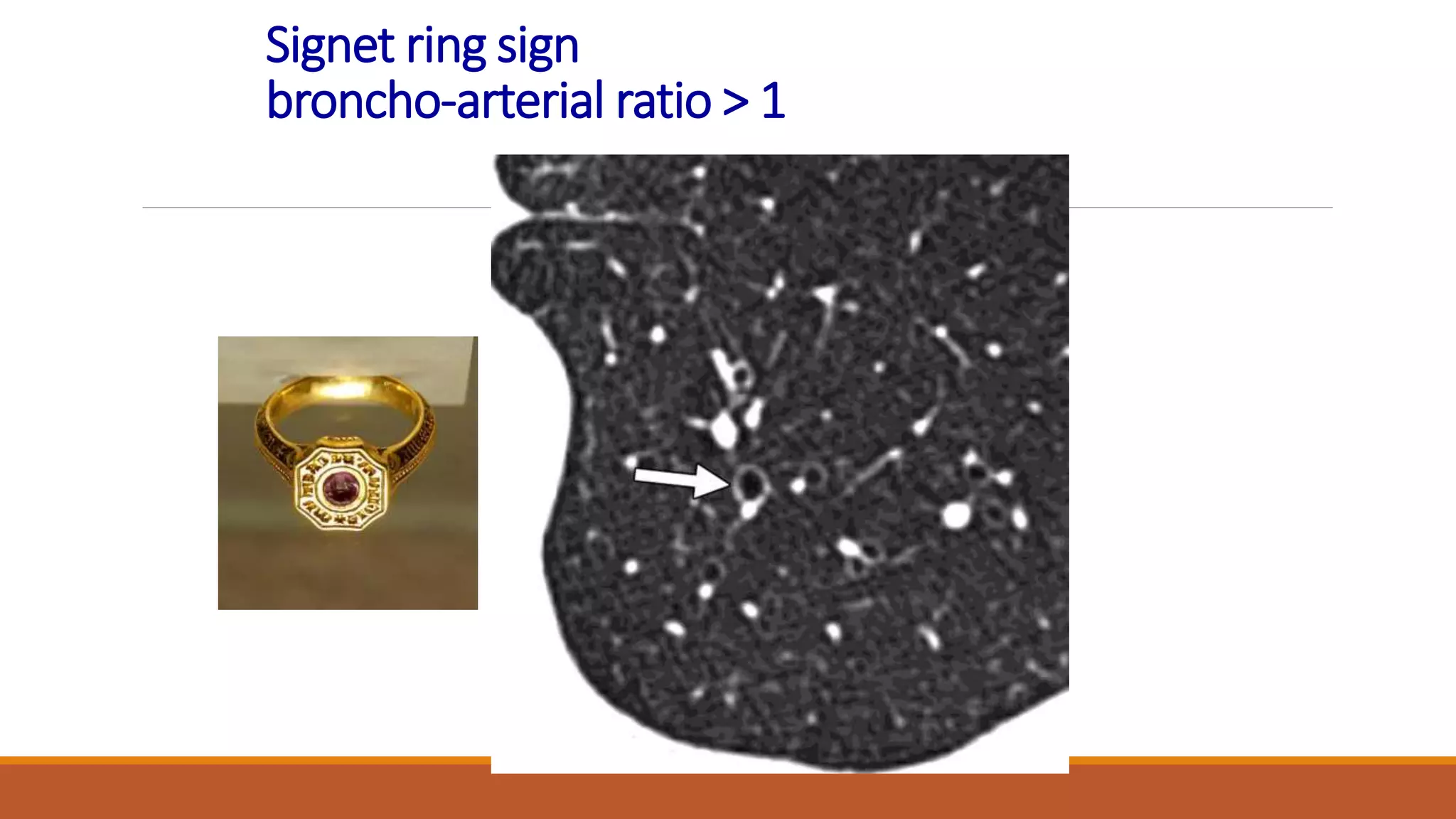 Signet ring sign
broncho-arterial ratio > 1
 