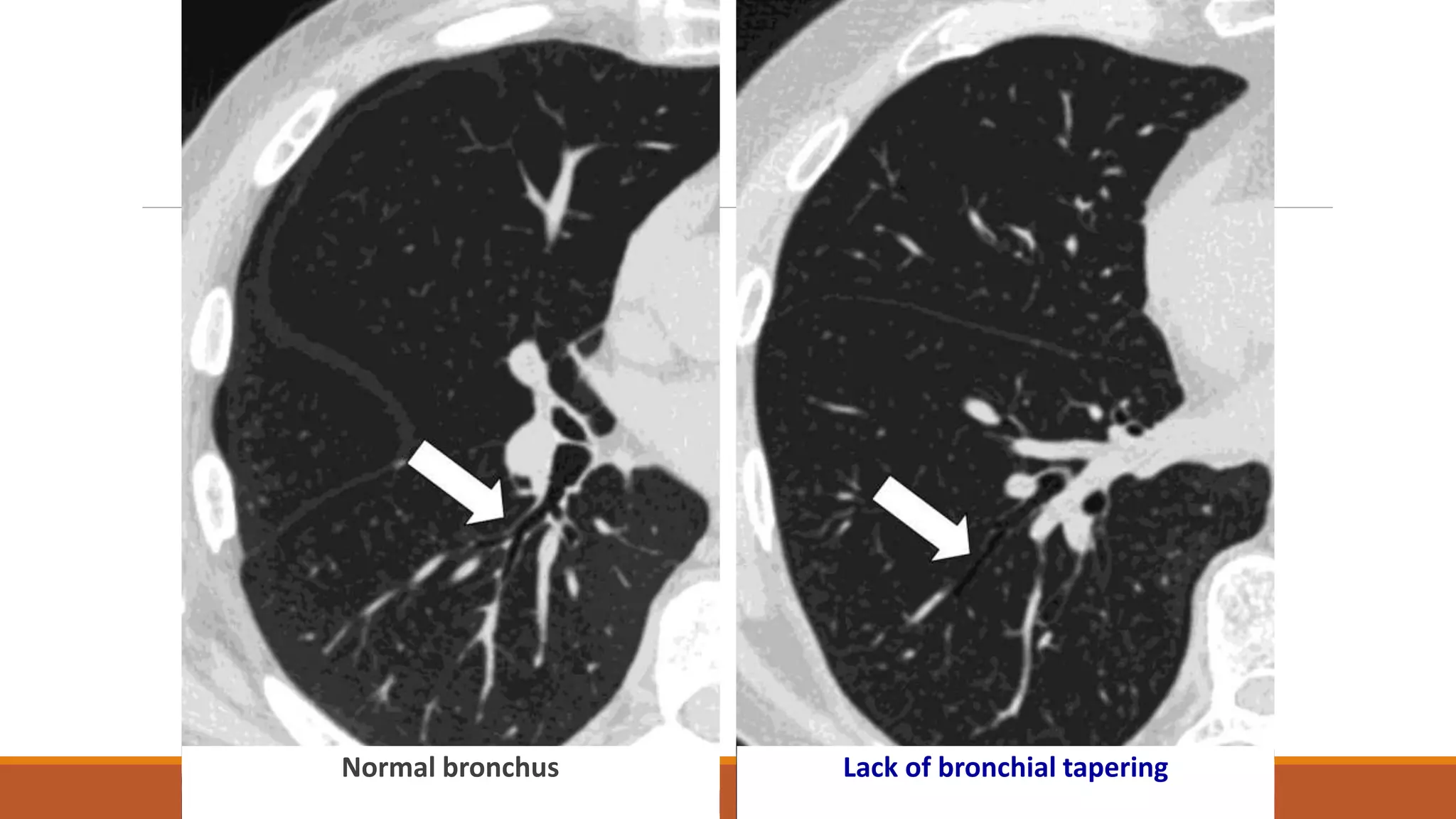 Normal bronchus Lack of bronchial tapering
 