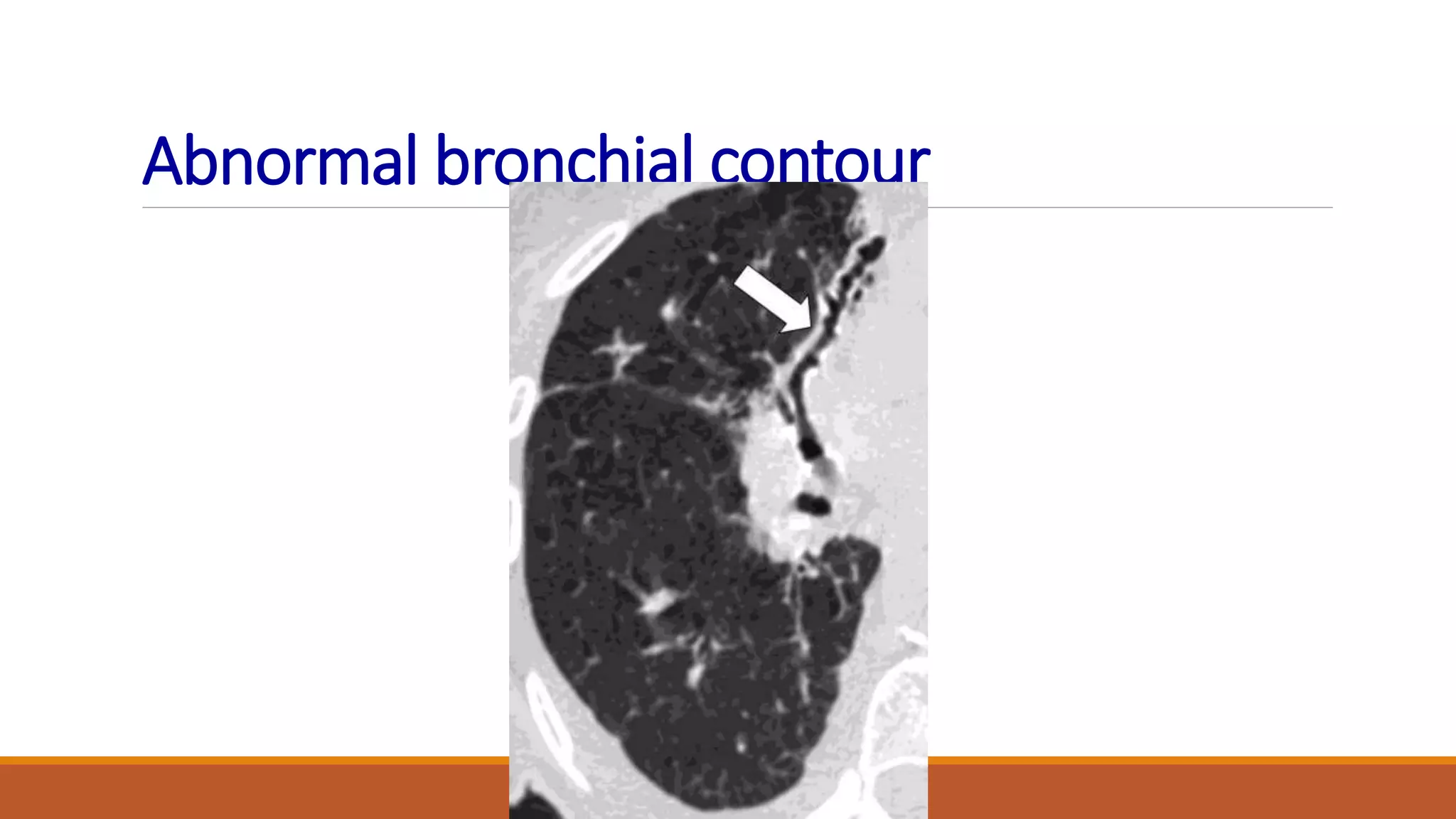 Abnormal bronchial contour
 