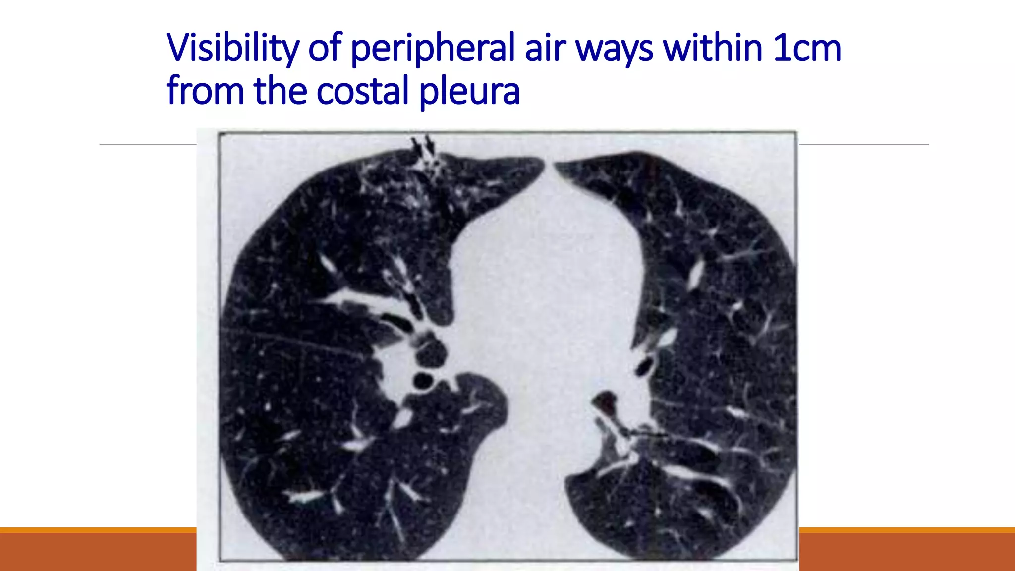 Visibility of peripheral air ways within 1cm
from the costal pleura
 