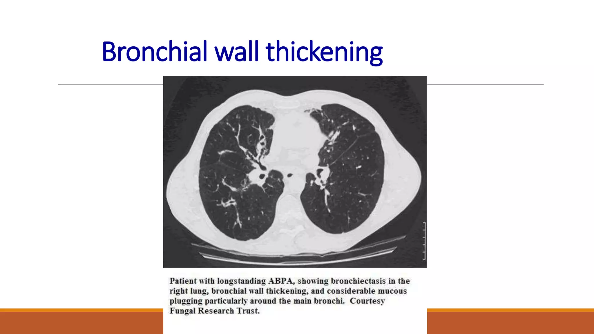 Bronchial wall thickening
 