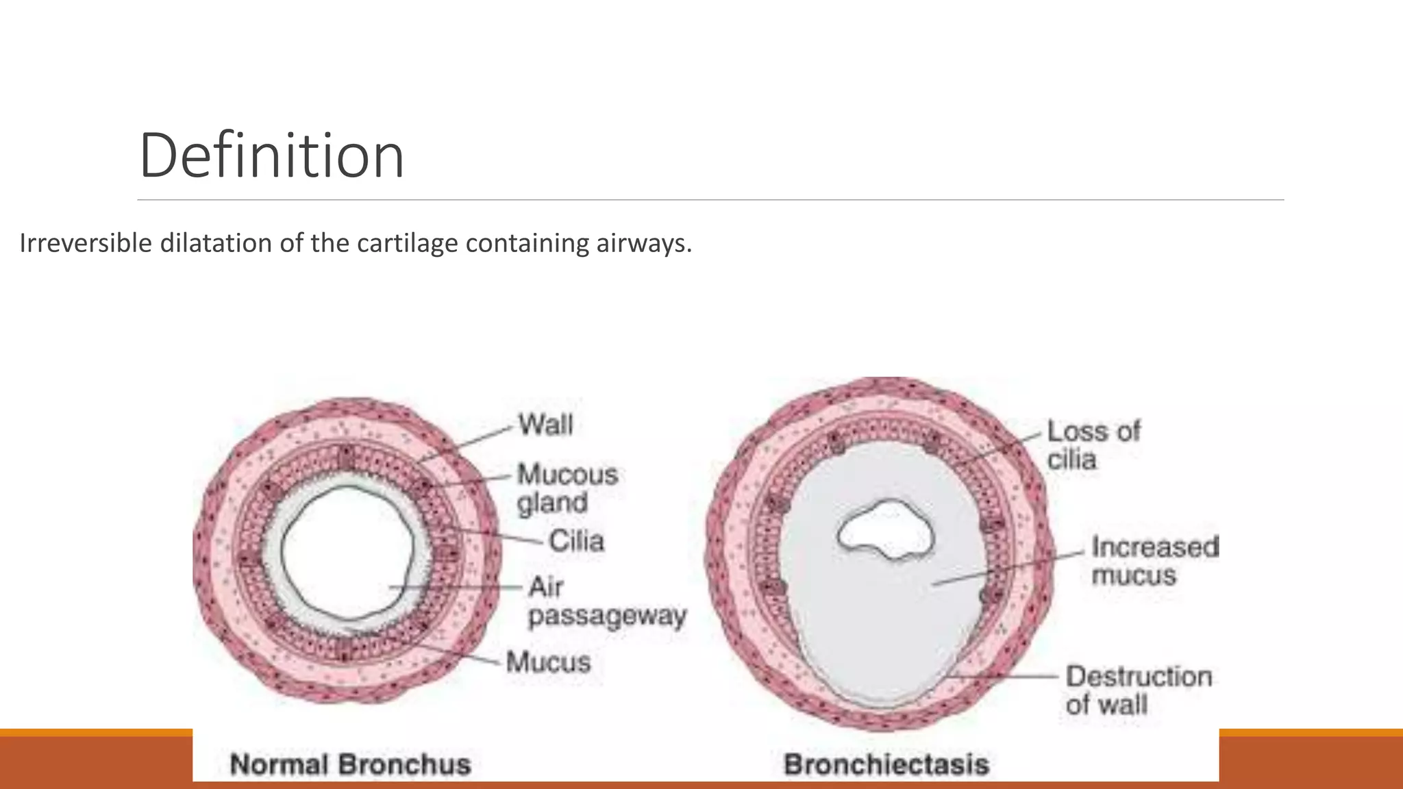 Definition
Irreversible dilatation of the cartilage containing airways.
 