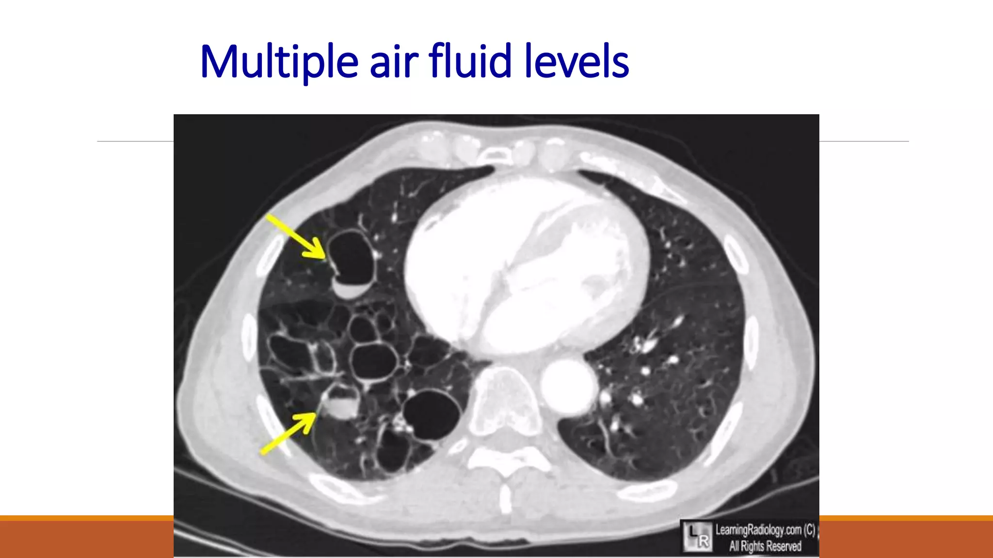 Multiple air fluid levels
 