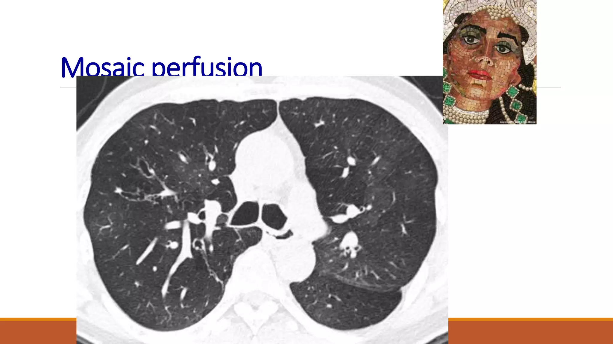 Mosaic perfusion
 