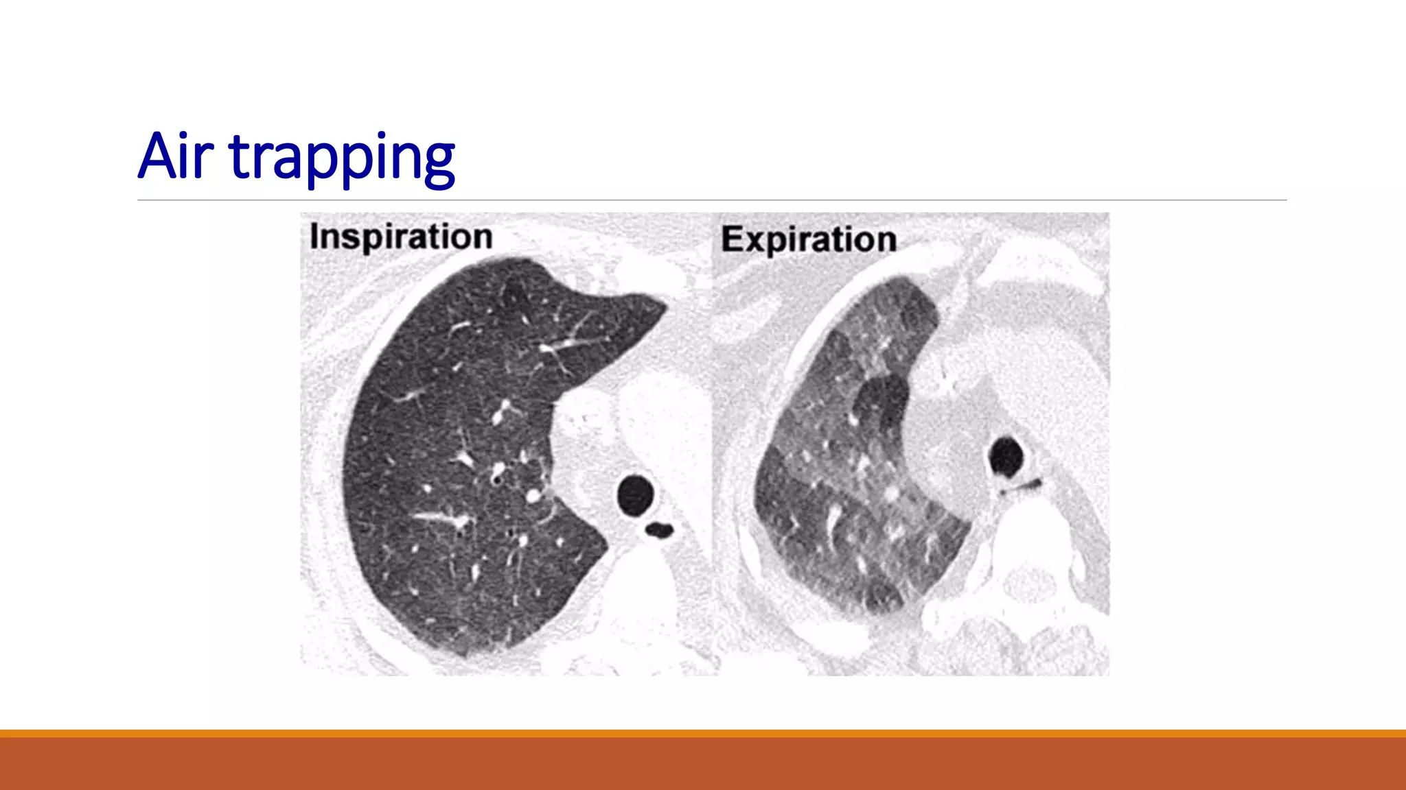 Air trapping
 