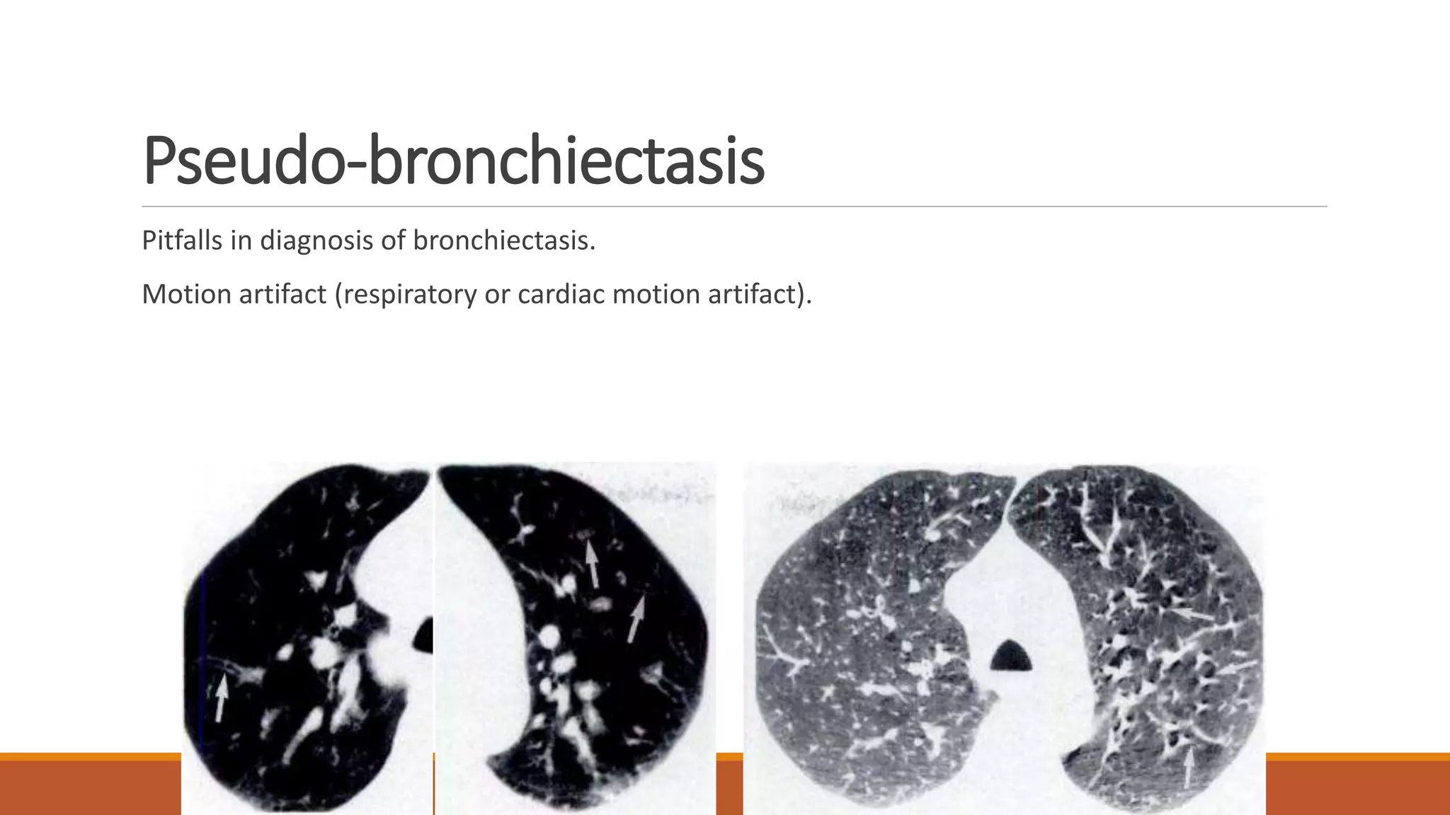 Pseudo-bronchiectasis
Pitfalls in diagnosis of bronchiectasis.
Motion artifact (respiratory or cardiac motion artifact).
 