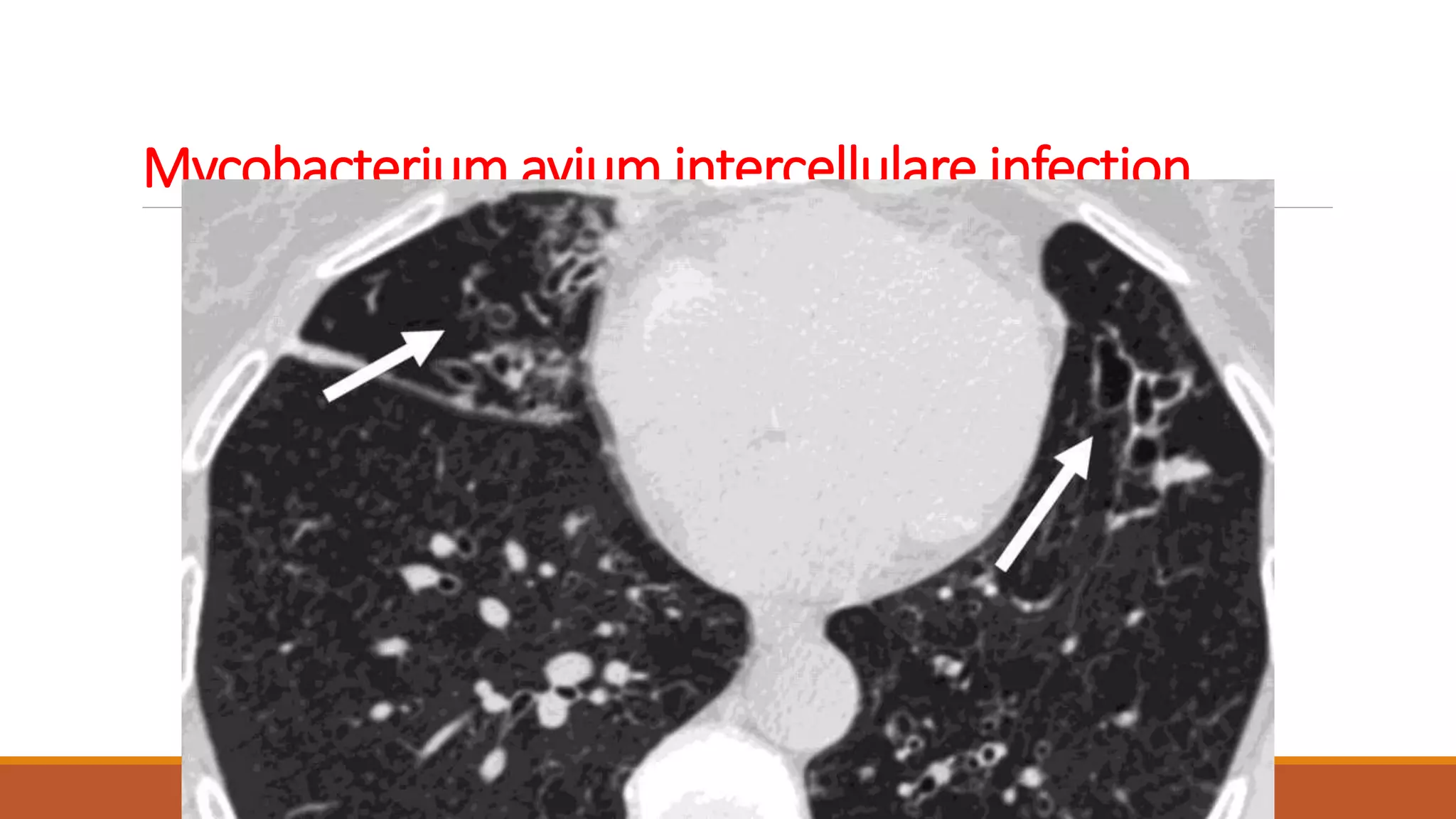 Mycobacterium avium intercellulare infection
 