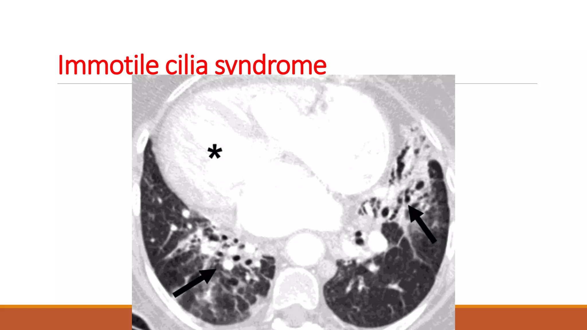 Immotile cilia syndrome
 