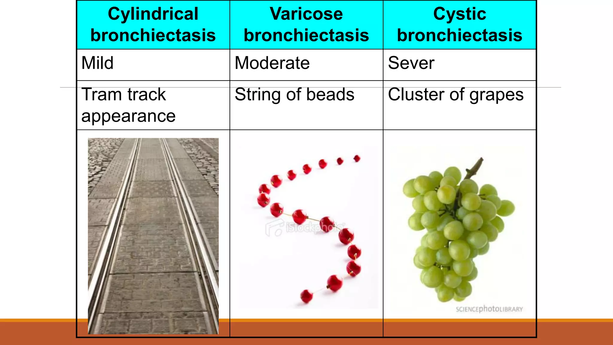 Cylindrical
bronchiectasis
Varicose
bronchiectasis
Cystic
bronchiectasis
Mild Moderate Sever
Tram track
appearance
String of beads Cluster of grapes
 