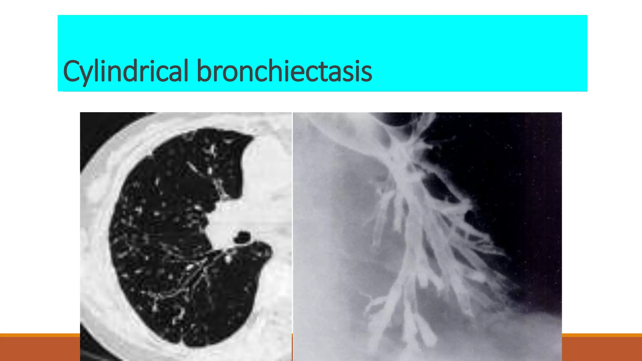 Cylindrical bronchiectasis
 