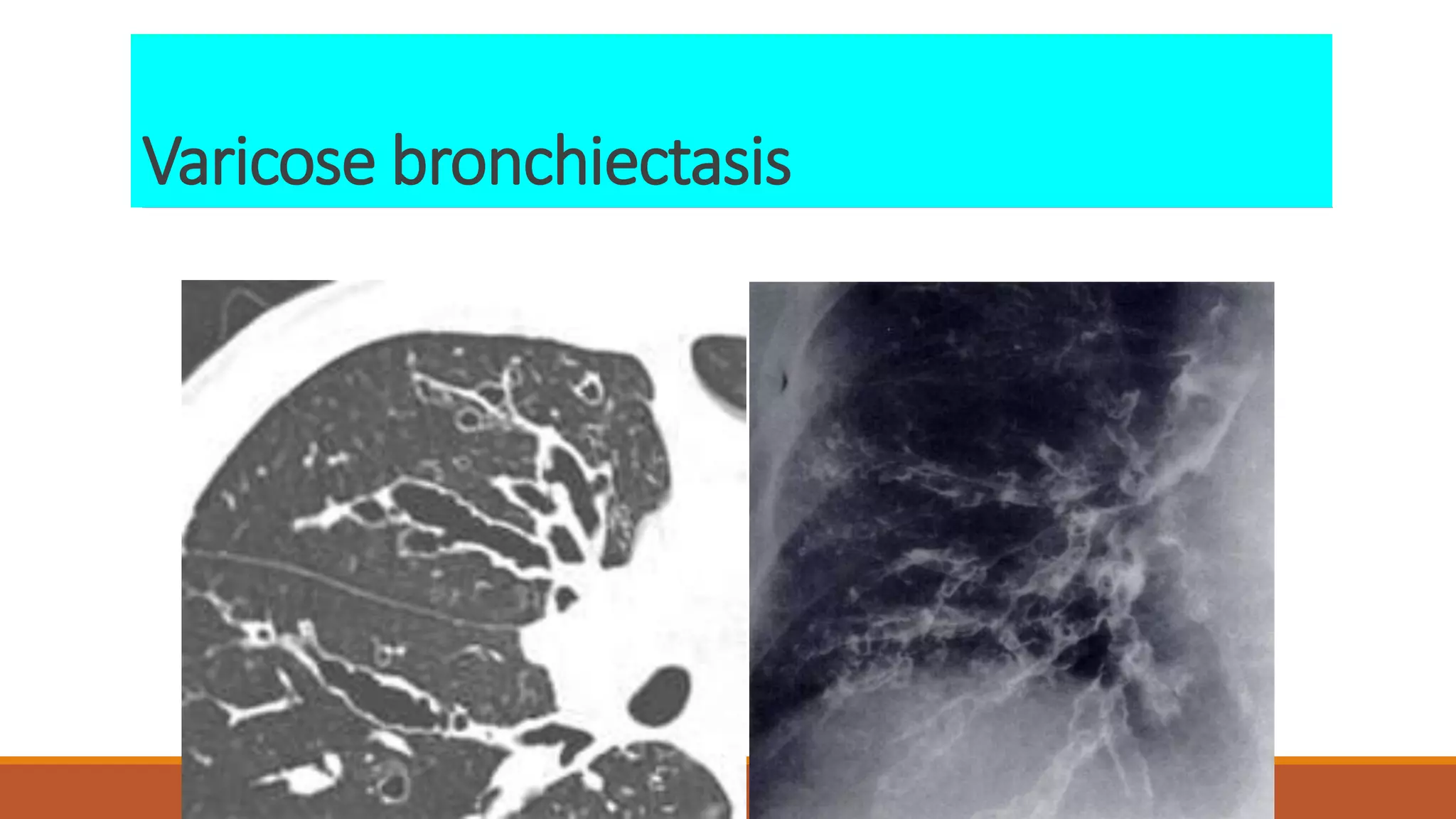 Varicose bronchiectasis
 