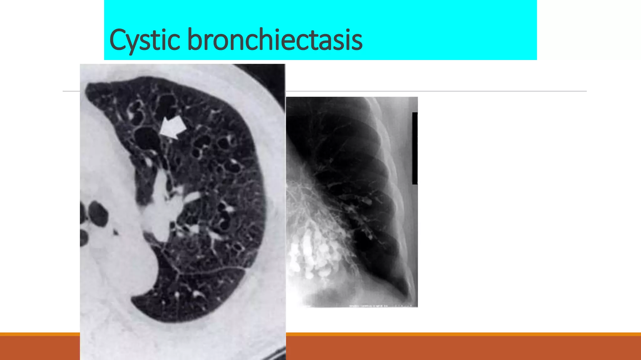Cystic bronchiectasis
 