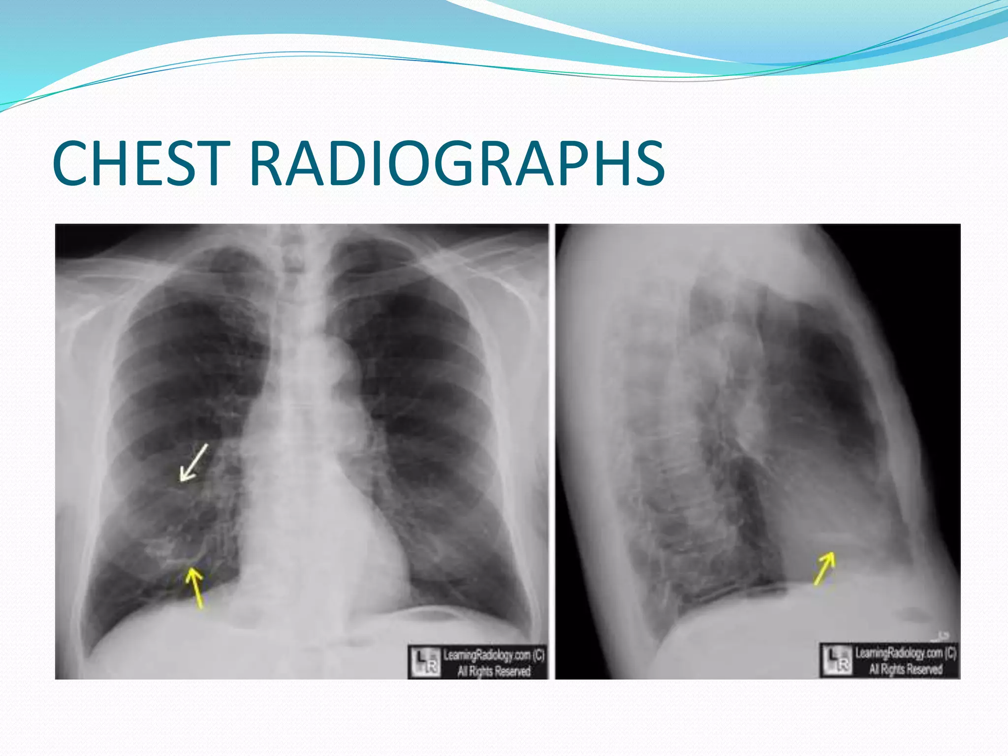 CHEST RADIOGRAPHS
 