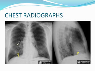CHEST RADIOGRAPHS
 