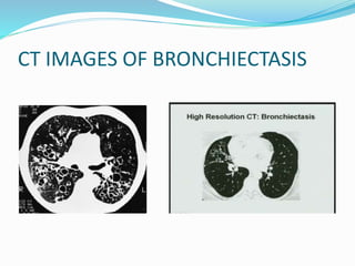CT IMAGES OF BRONCHIECTASIS
 