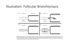 Illustration: Follicular Bronchiectasis
 
