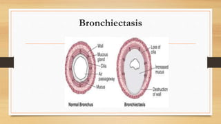 Bronchiectasis
 