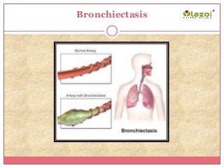 Bronchiectasis
 