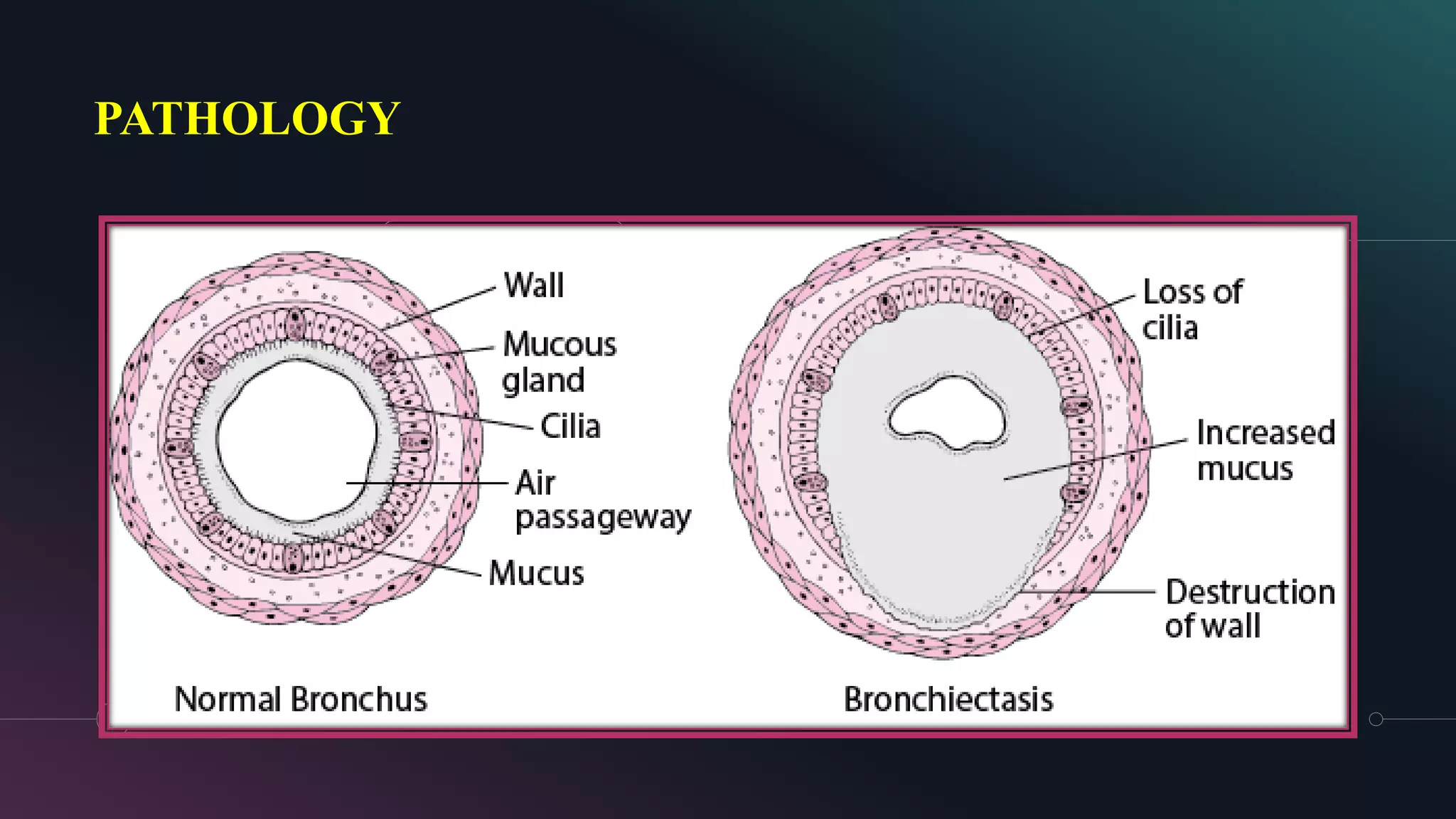 BRONCHIECTASIS | PDF