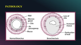 BRONCHIECTASIS | PDF