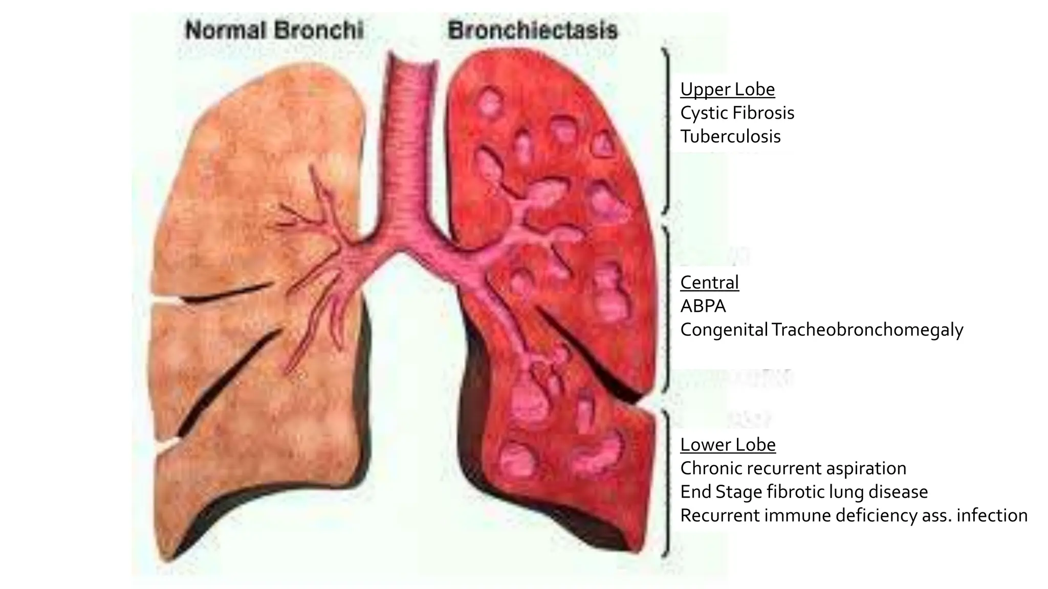 Bronchiectasis.pptx