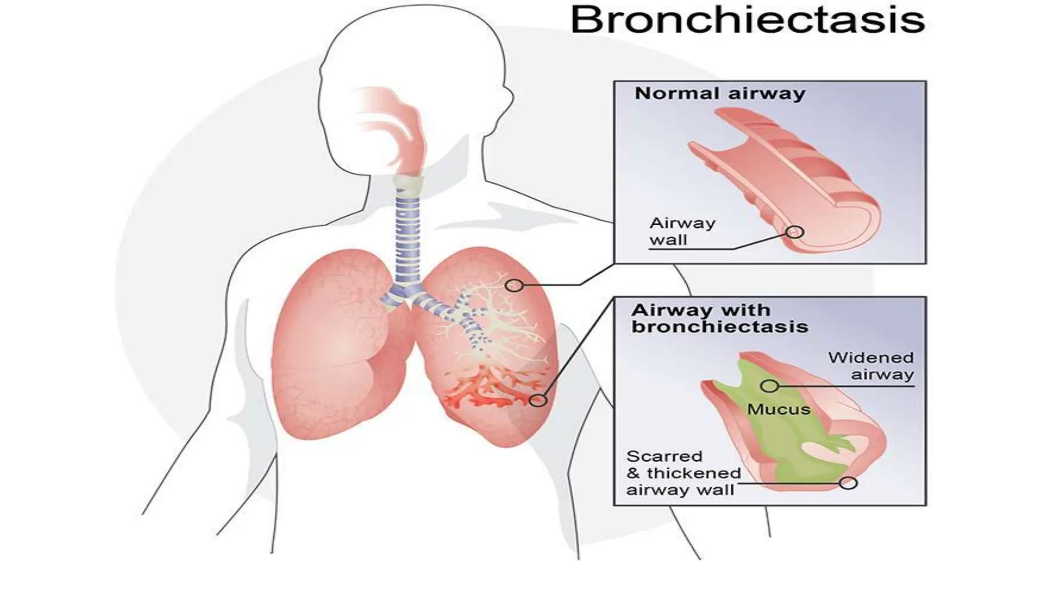 Bronchiectasis.pptx