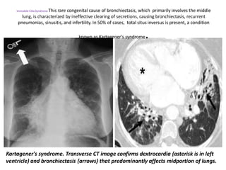 Kartagener's syndrome. Transverse CT image confirms dextrocardia (asterisk is in left
ventricle) and bronchiectasis (arrows) that predominantly affects midportion of lungs.
Immobile Cilia Syndrome This rare congenital cause of bronchiectasis, which primarily involves the middle
lung, is characterized by ineffective clearing of secretions, causing bronchiectasis, recurrent
pneumonias, sinusitis, and infertility. In 50% of cases, total situs inversus is present, a condition
known as Kartagener's syndrome.
 