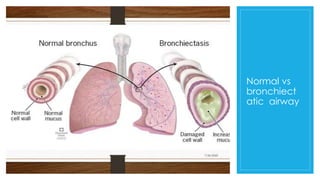 Bronchiectasis: An obstructive airway disease | PPTX