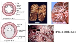 Bronchiectasis clinical diagnosis and management .pptx