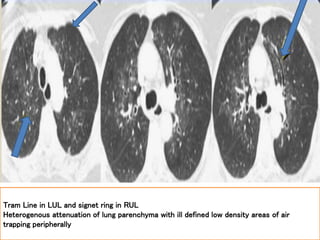 Tram Line in LUL and signet ring in RUL
Heterogenous attenuation of lung parenchyma with ill defined low density areas of air
trapping peripherally
 