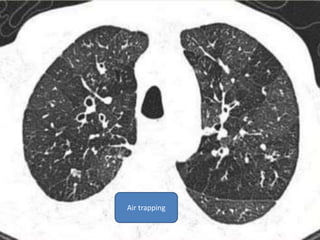 Air trapping
 