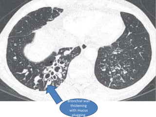 Bronchial wall
thickening
with mucus
plugging
 