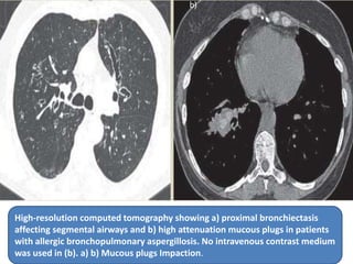High-resolution computed tomography showing a) proximal bronchiectasis
affecting segmental airways and b) high attenuation mucous plugs in patients
with allergic bronchopulmonary aspergillosis. No intravenous contrast medium
was used in (b). a) b) Mucous plugs Impaction.
 