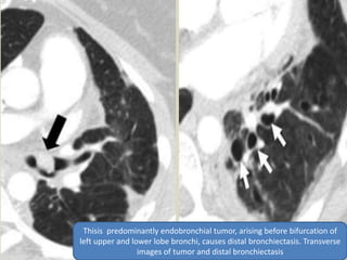 Thisis predominantly endobronchial tumor, arising before bifurcation of
left upper and lower lobe bronchi, causes distal bronchiectasis. Transverse
images of tumor and distal bronchiectasis
 