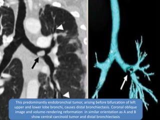 This predominantly endobronchial tumor, arising before bifurcation of left
upper and lower lobe bronchi, causes distal bronchiectasis. Coronal oblique
image and volume-rendering reformation in similar orientation as A and B
show central carcinoid tumor and distal bronchiectasis
 