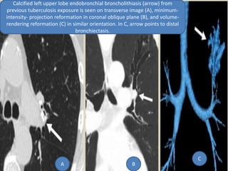 Calcified left upper lobe endobronchial broncholithiasis (arrow) from
previous tuberculosis exposure is seen on transverse image (A), minimum-
intensity- projection reformation in coronal oblique plane (B), and volume-
rendering reformation (C) in similar orientation. In C, arrow points to distal
bronchiectasis.
A B
C
 