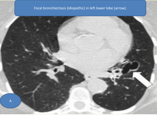 Focal bronchiectasis (idiopathic) in left lower lobe (arrow).
A
 