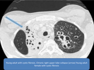 Young adult with cystic fibrosis. Chronic right upper lobe collapse (arrow) Young adult
female with cystic fibrosis
 