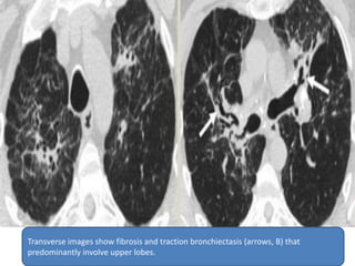 Transverse images show fibrosis and traction bronchiectasis (arrows, B) that
predominantly involve upper lobes.
 