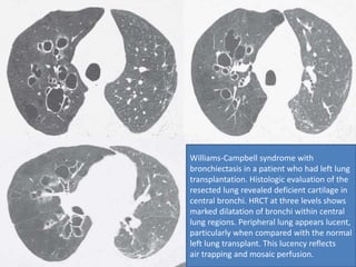 Williams-Campbell syndrome with
bronchiectasis in a patient who had left lung
transplantation. Histologic evaluation of the
resected lung revealed deficient cartilage in
central bronchi. HRCT at three levels shows
marked dilatation of bronchi within central
lung regions. Peripheral lung appears lucent,
particularly when compared with the normal
left lung transplant. This lucency reflects
air trapping and mosaic perfusion.
 