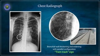 Chest Radiograph 
Bronchial wall thickening and widening 
with parallel configuration 
“Tram track” sign 
 