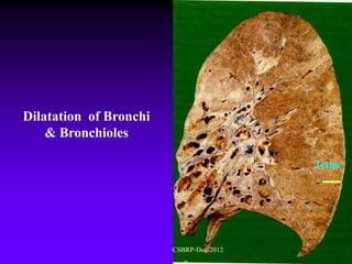 Dilatation of Bronchi
    & Bronchioles

                                         2cms




                        CSBRP-Dec-2012
 