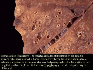 Bronchiectasis is seen here. The repeated episodes of inflammation can result in
scarring, which has resulted in fibrous adhesions between the lobes. Fibrous pleural
adhesions are common in persons who have had past episodes of inflammation of the
lung that involve the pleura. With extensiveCSBRP-Dec-2012 the pleural space may be
                                             involvement,
obliterated.
 