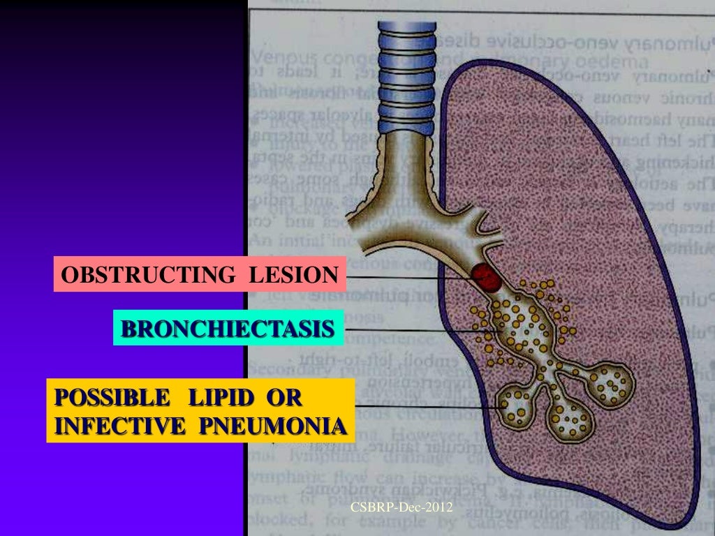 Bronchiectasis