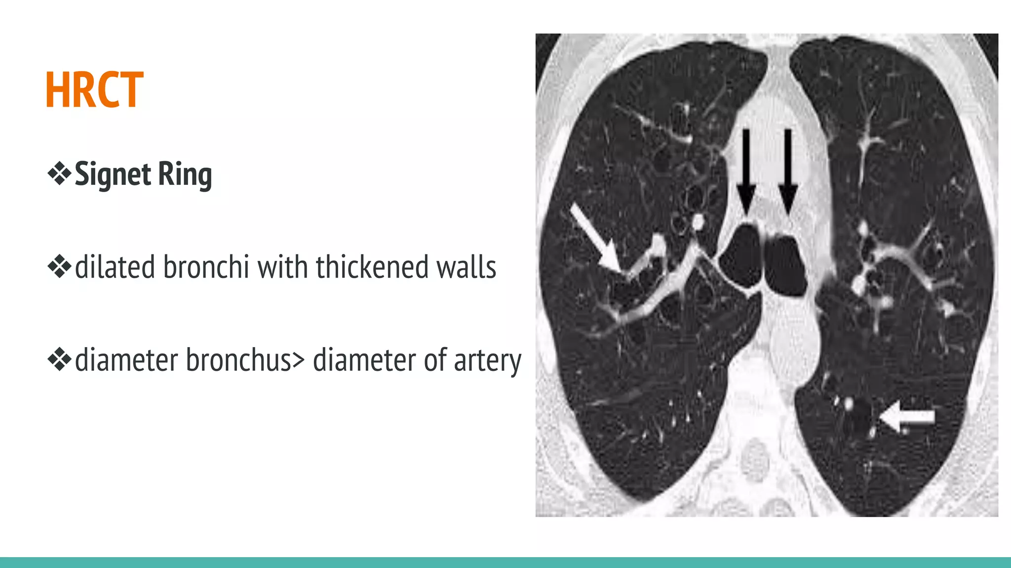 Bronchiectasis | PPTX